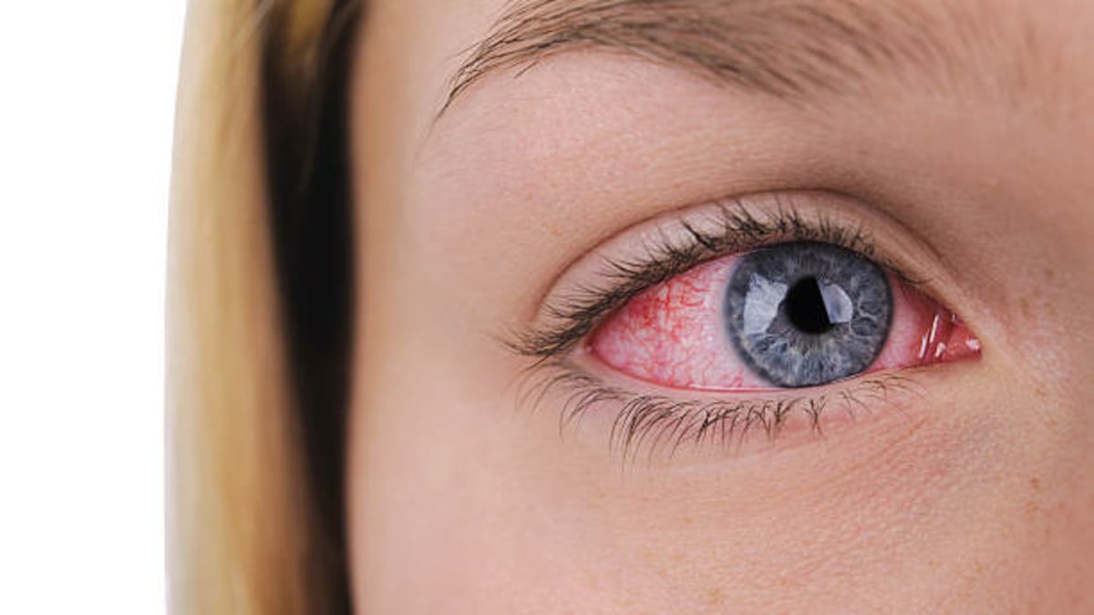 Göz kızarıklığının sebebi adenovirüs olabilir! – En Son Haber